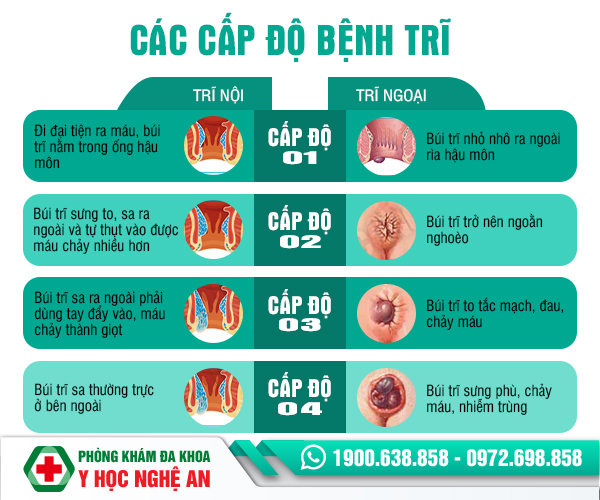 Cấp độ bệnh trĩ