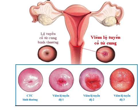 Bệnh viêm lộ tuyến cổ tử cung